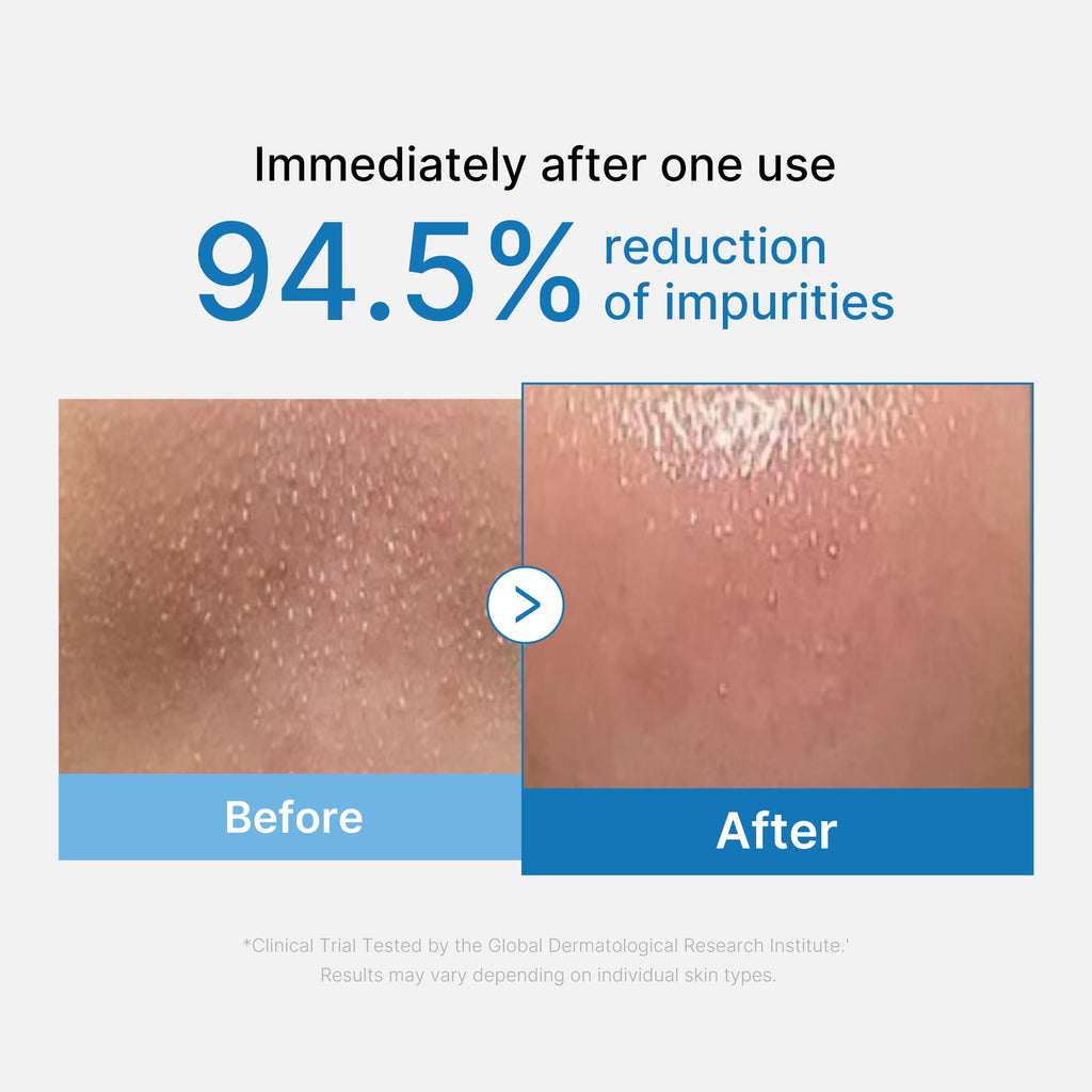 [Exclusive Deal] Amazon’s #1 Beauty Brand |  Zero Pore Blackhead Deep Cleansing Oil